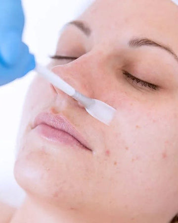 Chemical Peel